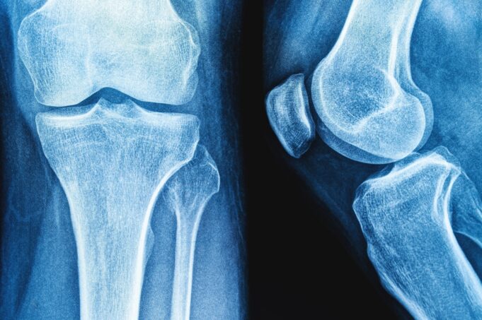 Study: Bone Health After Exercise Alone, GLP-1 Receptor Agonist Treatment, or Combination Treatment. ​​​​​​​Image Credit: siamionau pavel / Shutterstock