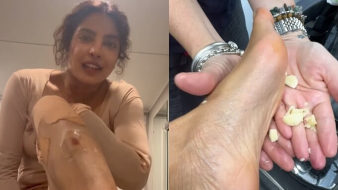 Priyanka Chopra suffered a few injuries while shooting in Australia